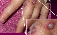 Bệnh đậu mùa khỉ lan rộng ở châu Âu và mới xuất hiện tại Mỹ