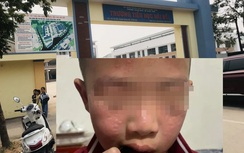 Hà Nội: Nhiều học sinh mẩn ngứa vùng mặt, sưng mắt sau khi trường phun thuốc diệt muỗi