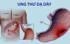 Dấu hiệu nào nhận biết ung thư dạ dày?