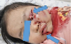 Mẹ không tắt máy xe, bé 26 tháng tuổi dập phổi, rách mí mắt vì vặn tay ga