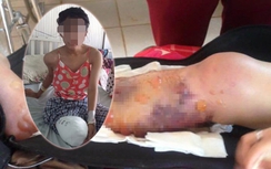 Nữ sinh bị cắt cụt chân: Bộ Y tế yêu cầu làm rõ