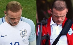 Rooney rụng tóc vì thất bại tại EURO 2016