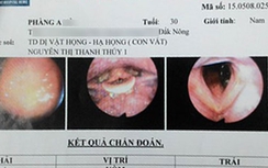 Gắp đỉa trong cuống họng bệnh nhân