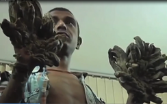 Video: Nam thanh niên có "bàn tay quỷ" được phẫu thuật