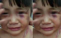 Bênh mẹ, bé 3 tuổi bị cha dượng đánh đa chấn thương