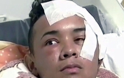 Thanh niên bị dao đâm xuyên mắt đến não sống sót thần kỳ