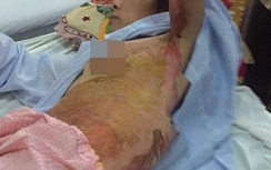 Bình Thuận: Chồng phóng hỏa đốt nhà, hai mẹ con bỏng nặng