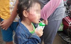 Vụ bé gái bị tát sưng mặt: Phát hiện cục máu bầm trong tai
