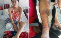 Bác sĩ tắc trách, thiếu nữ xinh xắn 16 tuổi bị cưa một chân