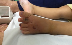 Nhiều trẻ nhỏ bị rắn độc cắn phải nhập viện