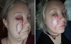 Người phụ nữ bị ung thư da do vết sẹo thủy đậu lúc bé