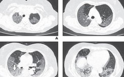 Hình ảnh phổi bệnh nhân nhiễm Covid-19 bị virus Corona tàn phá