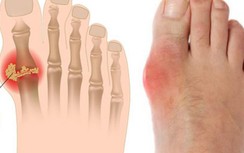 Những thói quen cần thay đổi để tạm biệt bệnh Gout