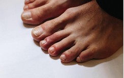 Ngón chân bất thường: Triệu chứng lạ cảnh báo nguy cơ mắc COVID-19