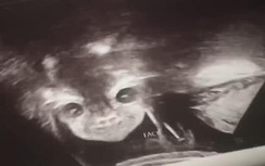Thú vị hình ảnh siêu âm thai nhi 24 tuần tuổi mở mắt, cười bí hiểm