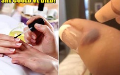 Người phụ nữ bị nhiễm "virus ăn thịt" sau khi đi làm móng tay