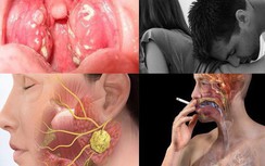 Ngoài "yêu" bằng miệng, đây là những nguyên nhân chính gây ung thư vòm họng