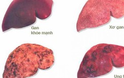 Giám đốc BV K hướng dẫn cách phòng bệnh ung thư có tỷ lệ mắc mới nhiều nhất tại Việt Nam