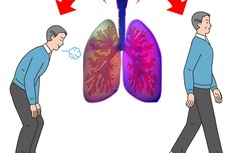 5 triệu chứng ung thư phổi nhiều người không hề hay biết