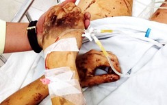 Vụ Việt kiều bị tạt axit, cắt gân: Ráo riết điều tra thủ phạm