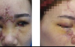 Nữ bệnh nhân mù mắt sau khi tiêm filler nâng mũi làm đẹp