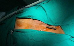 Kinh hãi nam bệnh nhân 38 tuổi bị thanh sắt đâm xuyên đùi lên bụng