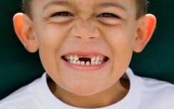 Nguy hiểm không ngờ khi không thấy trẻ mọc răng sau 2 tháng nhổ răng sữa