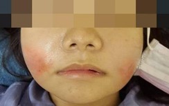 Cô gái mặt phồng như trái bóng do tiêm filler làm đẹp