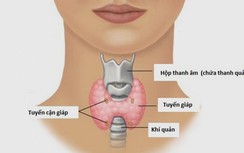 Ung thư tuyến giáp có điều trị dứt điểm được không?