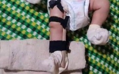 Vụ bé 2 tháng tuổi bị gãy chân: Người cha khai sơ ý dẫm chân con