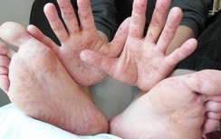 Bệnh nhi tay-chân-miệng tăng 5-6 lần, nhiều biến chứng nguy hiểm