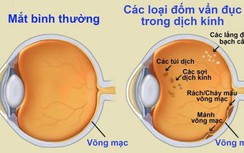 Hiện tượng “ruồi bay” trong mắt có nguy hiểm?