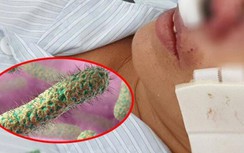 Xác định nhiều bệnh nhân nhiễm vi khuẩn "ăn thịt người" ở Quảng Trị