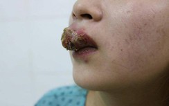 Xăm môi giá 2 triệu đồng, cô gái trẻ ở Đồng Nai nhập viện vì tai biến nặng