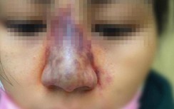 Cô gái 25 tuổi hoại tử mũi, trán sau tiêm filler, bác sĩ khuyến cáo gì?