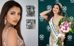 Sốc: Á hậu Miss World 2021 từng bị biến dạng mặt vì tai nạn kinh hoàng