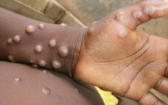 Bộ Y tế đề nghị sớm tiếp cận nguồn cung thuốc điều trị đậu mùa khỉ