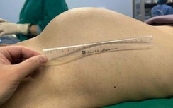 Bệnh nhân bị khối u ác tính hiếm gặp 5,5kg, bụng to như "bầu 5 tháng"