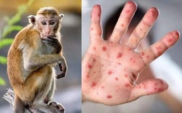 Long An: Phát hiện người đàn ông dương tính với virus đậu mùa khỉ