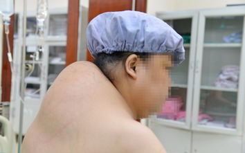 Khối u mỡ khổng lồ gây biến dạng vai gáy người phụ nữ ở Hà Nội