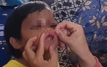 Bắt giam cha nuôi bạo hành bé gái 4 tuổi ở Cà Mau