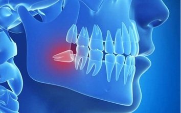 Răng số 8 mọc lệch không đau, có nên nhổ?