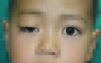 Sụp mi mắt ở trẻ nhỏ có nguy hiểm?