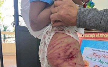 Hà Tĩnh: Xác minh vụ bé gái lớp 5 nghi bị cha dượng bạo hành
