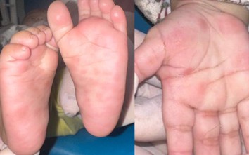 Bất ngờ phát hiện trẻ sơ sinh mắc giang mai từ dấu hiệu này