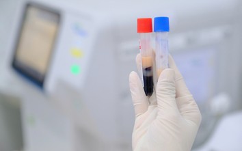 Nuông chiều bản thân, nhiều người mỡ máu tăng vọt