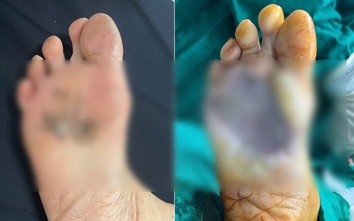 Ung thư da tiềm ẩn từ tổn thương không đau, không ngứa