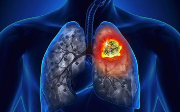 Trắc nghiệm: Người mắc ung thư phổi tuyệt đối không được nhầm lẫn những điều này