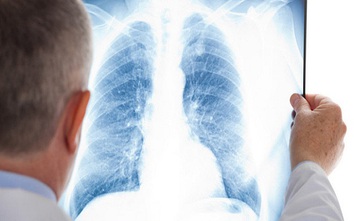6 lầm tưởng về ung thư phổi khiến ai cũng ngỡ ngàng khi biết sự thật