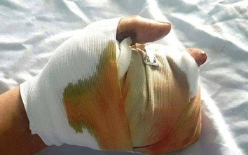 Hai cháu bé ở Đồng Nai bị dập nát bàn tay do pháo nổ